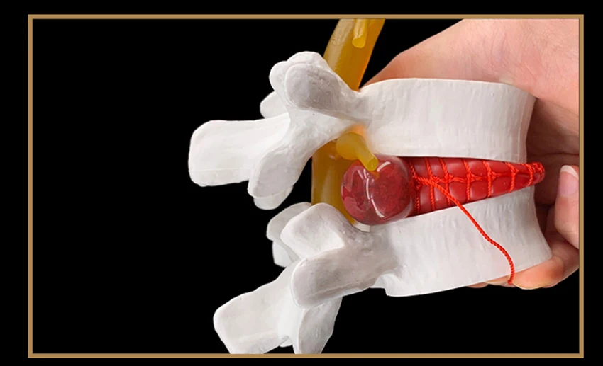 Herniation Demonstration Model, Modelo de Coluna Humana-Branco, Amarelo