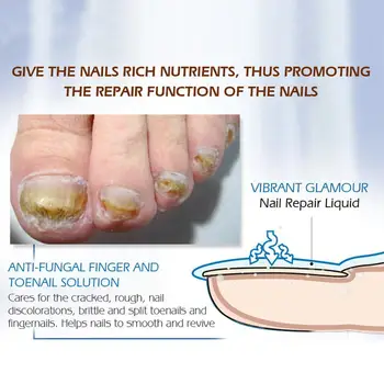 

Nail Repair Serum Nail Treatment Fungus Onychomycosis Anti Nourishing Fungus Nail Removal Care Toe 15ml Nail Q3N7