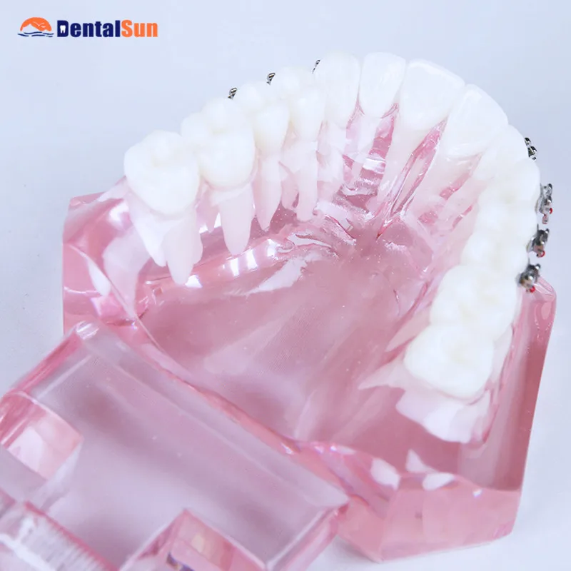 Стоматологический M3001 ортодонтический, для зубов Модель с металлическим кронштейном
