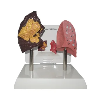 

Teaching Health And Disease Lungs Comparison Model