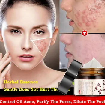

Multiple Effect Acne Cream Moisturizing Remove Acne Marks Pimples Herbal Anti-acne Cream
