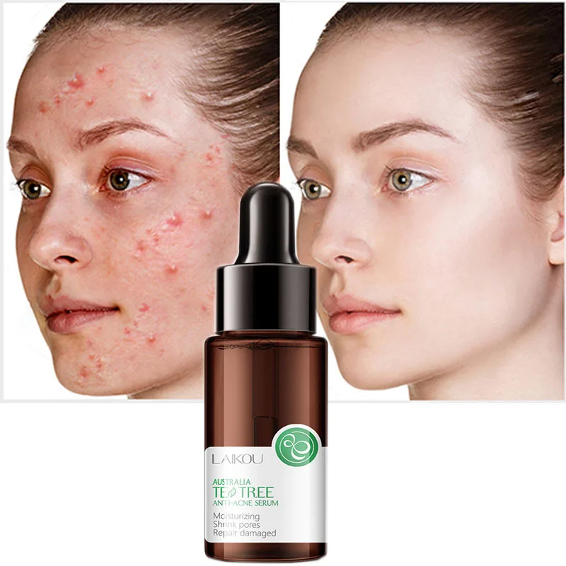 

LAIKOU Face Serum 100% Plant Tea Tree Acne Repair Scar Acne Treatment Oil Control Cream Anti Acne Marks For Sensitive Skin Care