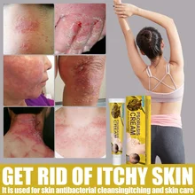 Skin Moss Removal Cream Moss Versicolor Sweat Spot Sweat Spot Itchy Skin Antibacterial Cream Skin Whitening Cream