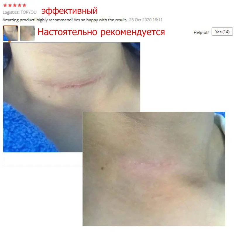 Acne Scar Removal Cream Gel Face Pimples Stretch Marks Cream Repairing Smoothing Whitening Moisturizing Body Cream Skin Care 30g-4