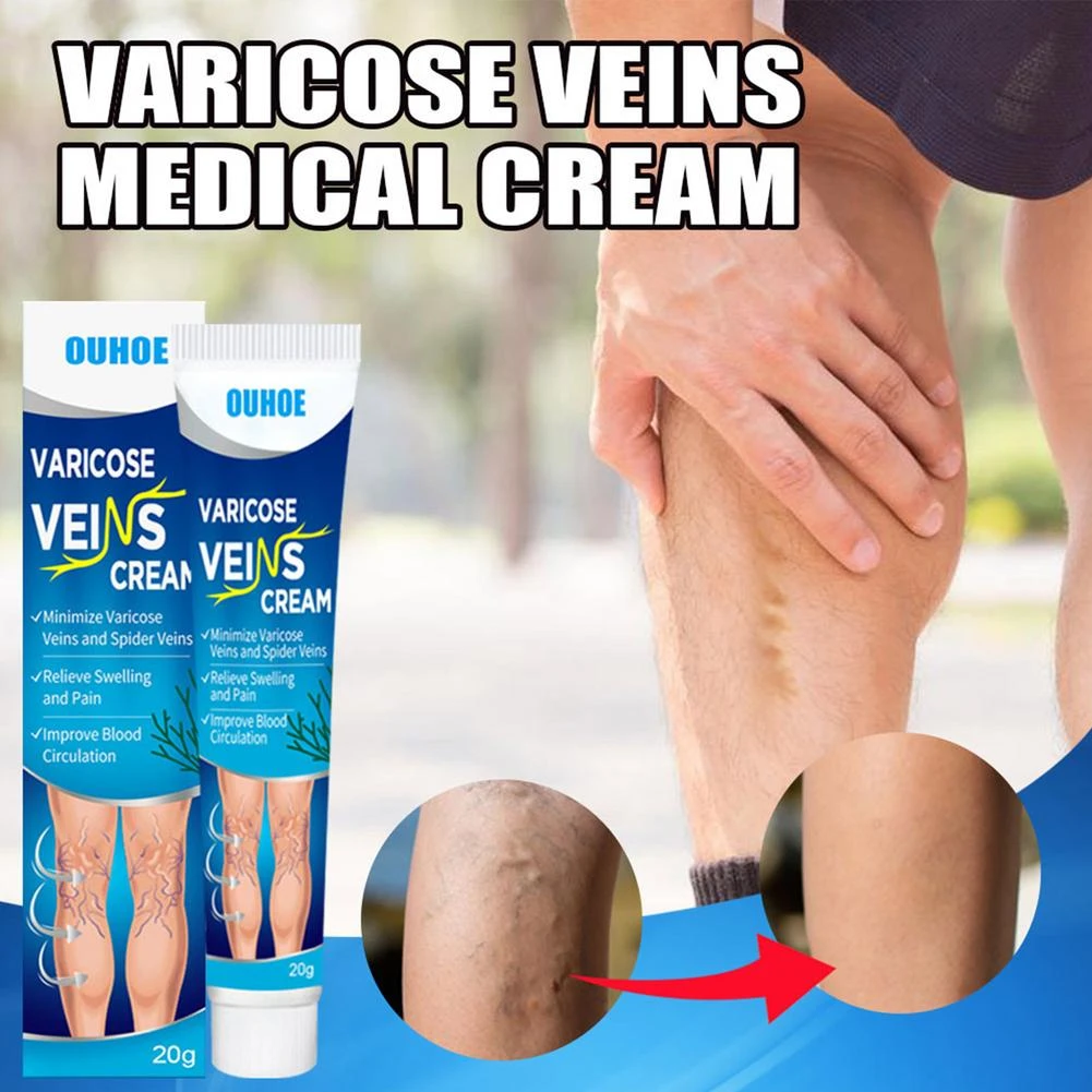 2Types Varicose Vein Ointment Phlebitis Vasculitis Treatment Cream