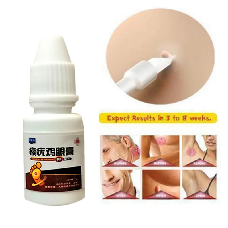 Best Price Cream Wart-Remover Skin-Tags Treatment Foot-Corn-Removal 10ml Genital NRwoepNeGbG