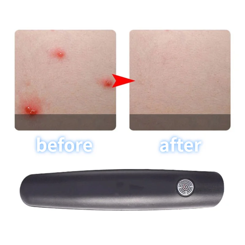 

Antipruritic Pen Neutralizing Irritation Relieve Stings Itching Pencil Relieve Mosquito Bites Pen Mosquito Antipruritic Device
