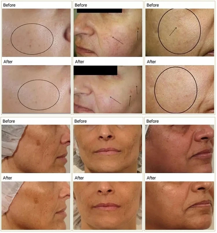 3-in-1 CO2 Nano Bubbles Oxygen Facial Machine for Skin Rejuvenation, Tightening & Lifting | Spa & Salon Use