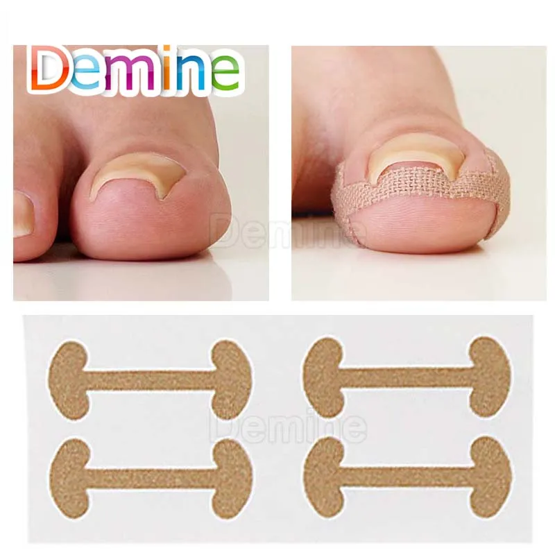 

New Foot Care Tools Toenail Correction Pedicure Line Fixer Paronychia Recovery Tool Nail Correction Patch