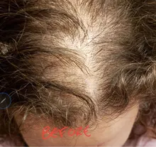 Productos para la pérdida de cabello, Productos naturales sin efectos secundarios para el crecimiento rápido del cabello y el rejuvenecimiento del cabello