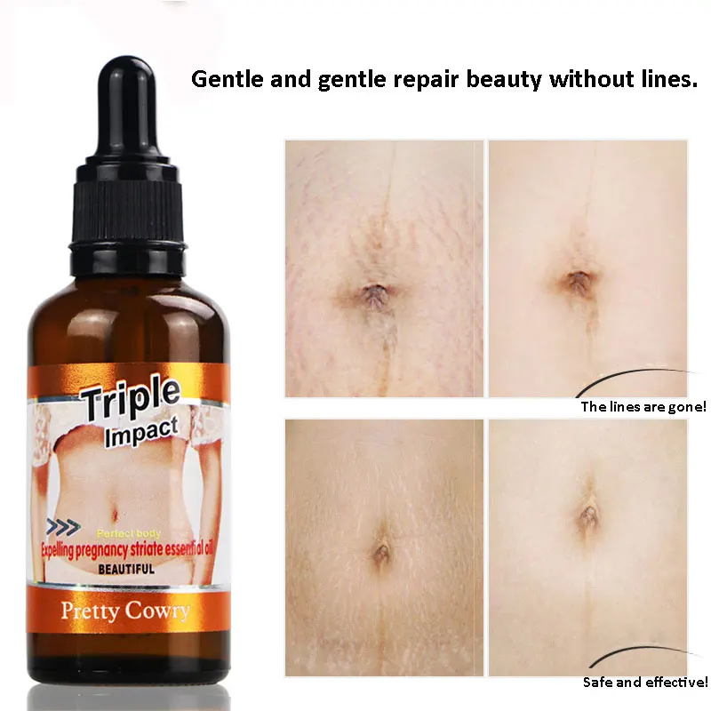 Крем Для Удаления растяжек эфирное масло для ухода за кожей беременных|Эфирное
