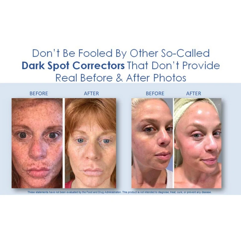Отбеливающий крем для лица, удаляющий веснушки, мелазма, прыщи, Осветляющий кожу, увлажняющий и укрепляющий кожу, крем для ухода за лицом