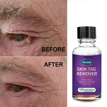 

20/30/40g Mole Skin Tag Removal Solution Painless Mole Skin Dark Spot Removal Face Wart Tag Removal liquid Wart Treatment TSLM1