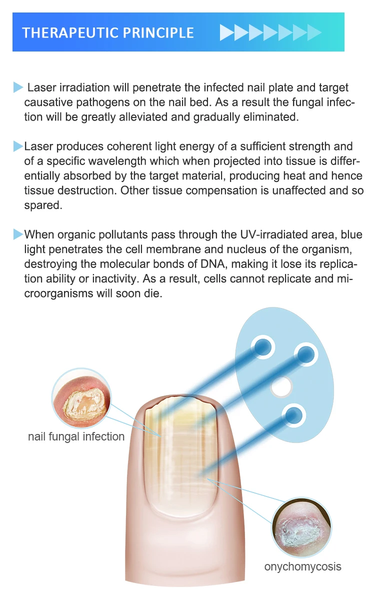 nail fungus laser device 7