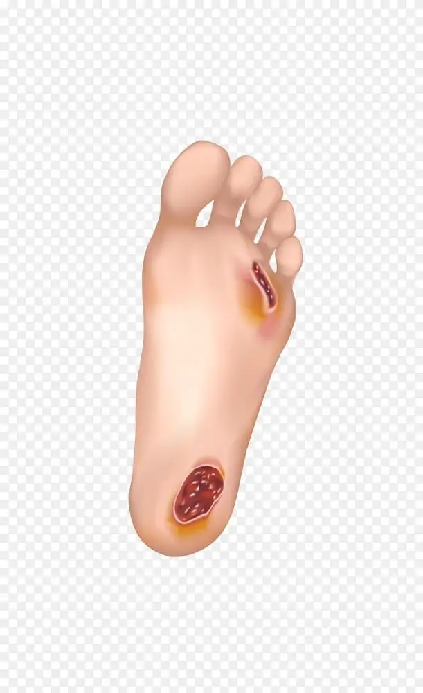 糖尿病足溃疡png图片素材免费下载 图片编号2185716 Png素材网