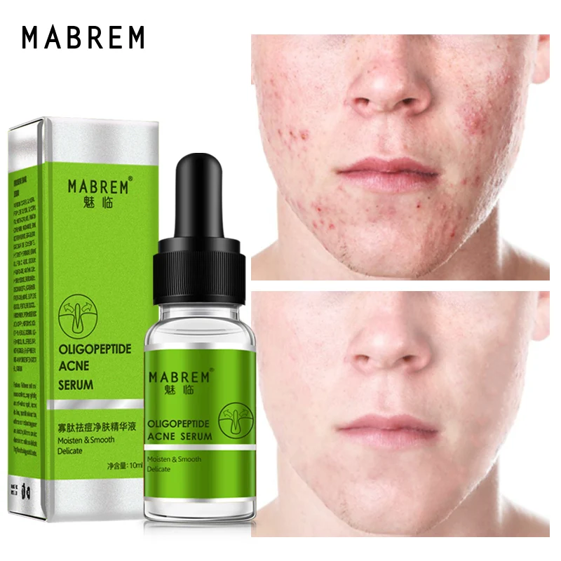 

MABREM Oligopeptide Acne Treatment Serum Deep Cleaning Shrink pores Repair Remove Acne Lotion Whitening Brighten Essence Care