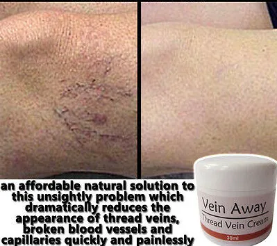 

Remove ugly Spider / Thread Veins! Pain Free and Quick! 30ML
