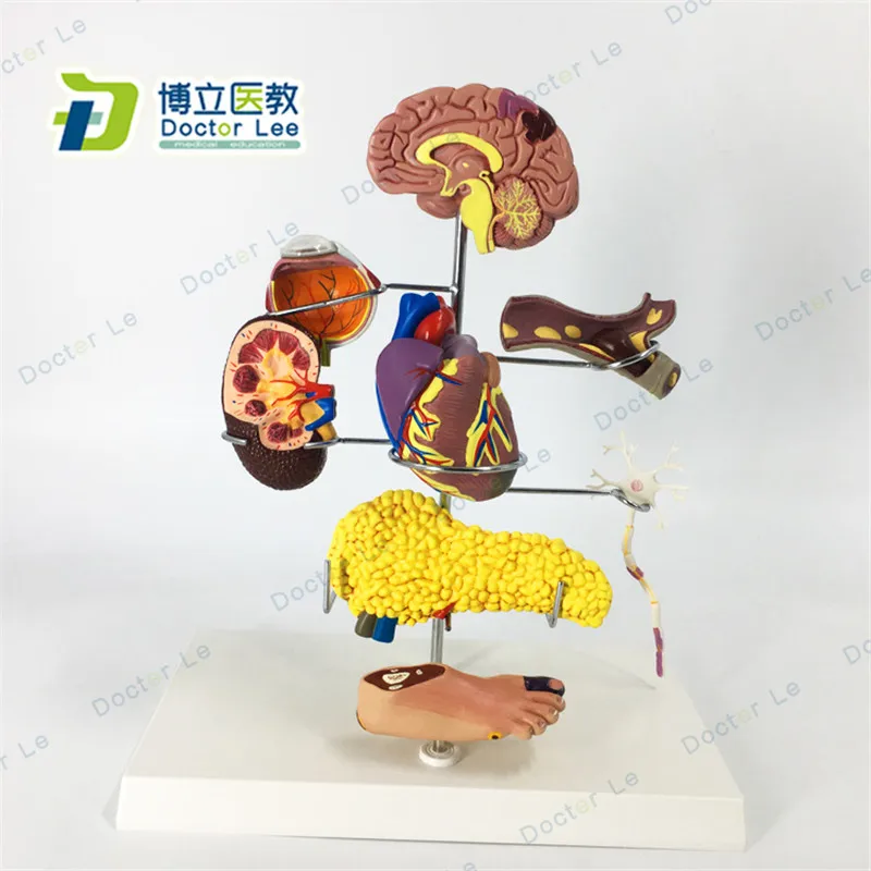 

8 Parts Half Life Size Diabetic Complications Anatomy Model with Brain Heart and Feet for Medical Teaching and Demonstration