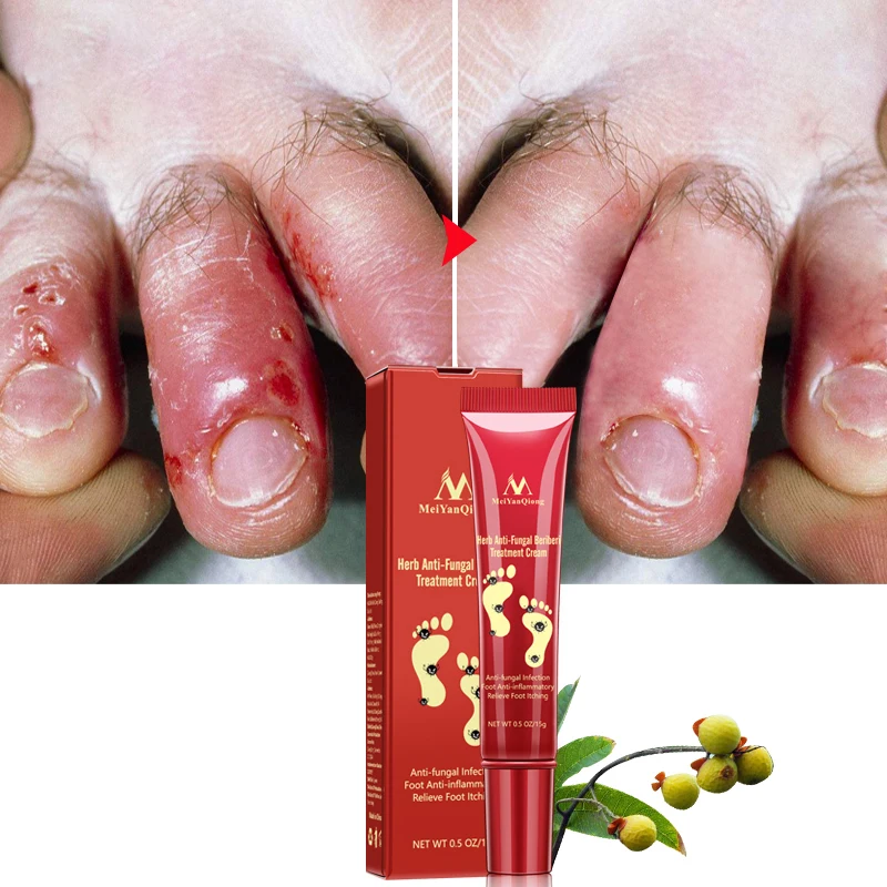 Meiyanqiong крем для ухода за ногами для удаления омертвевшей кожи против грибков, лечение берибери питательный крем для кожи ног MY031