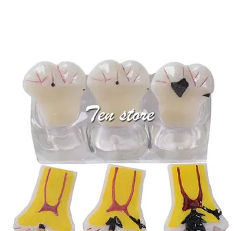 

Dental four times model caries evolution model caries caries patient-patient communication development pathology model demonstra