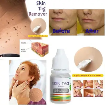 

Skin Tag Remover 12 Hours 10ml Skin Tag Remover/Mole Remover/Wart Remover Works All Natural Treatment TSLM1