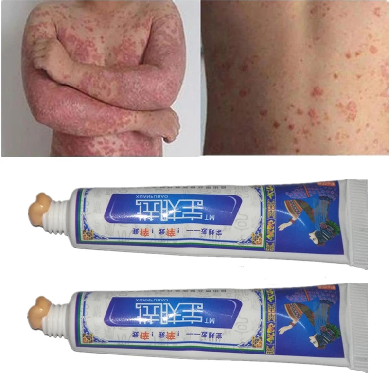 Herbal Skin Care Psoriasis Cream Ointment Pruritus Dermatitis Eczema
