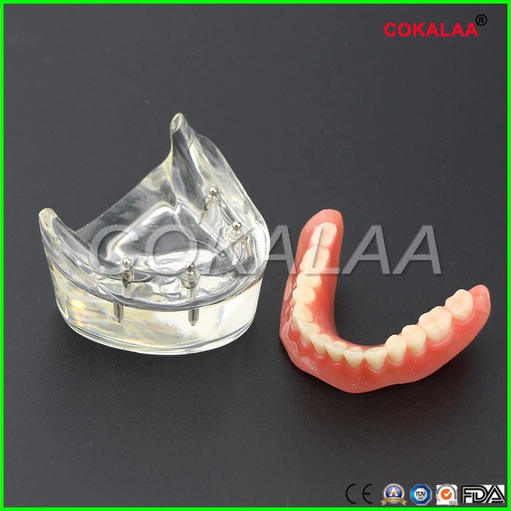 Стоматологическая модель исследования зубов Overdenture NOR Implant Demo модель
