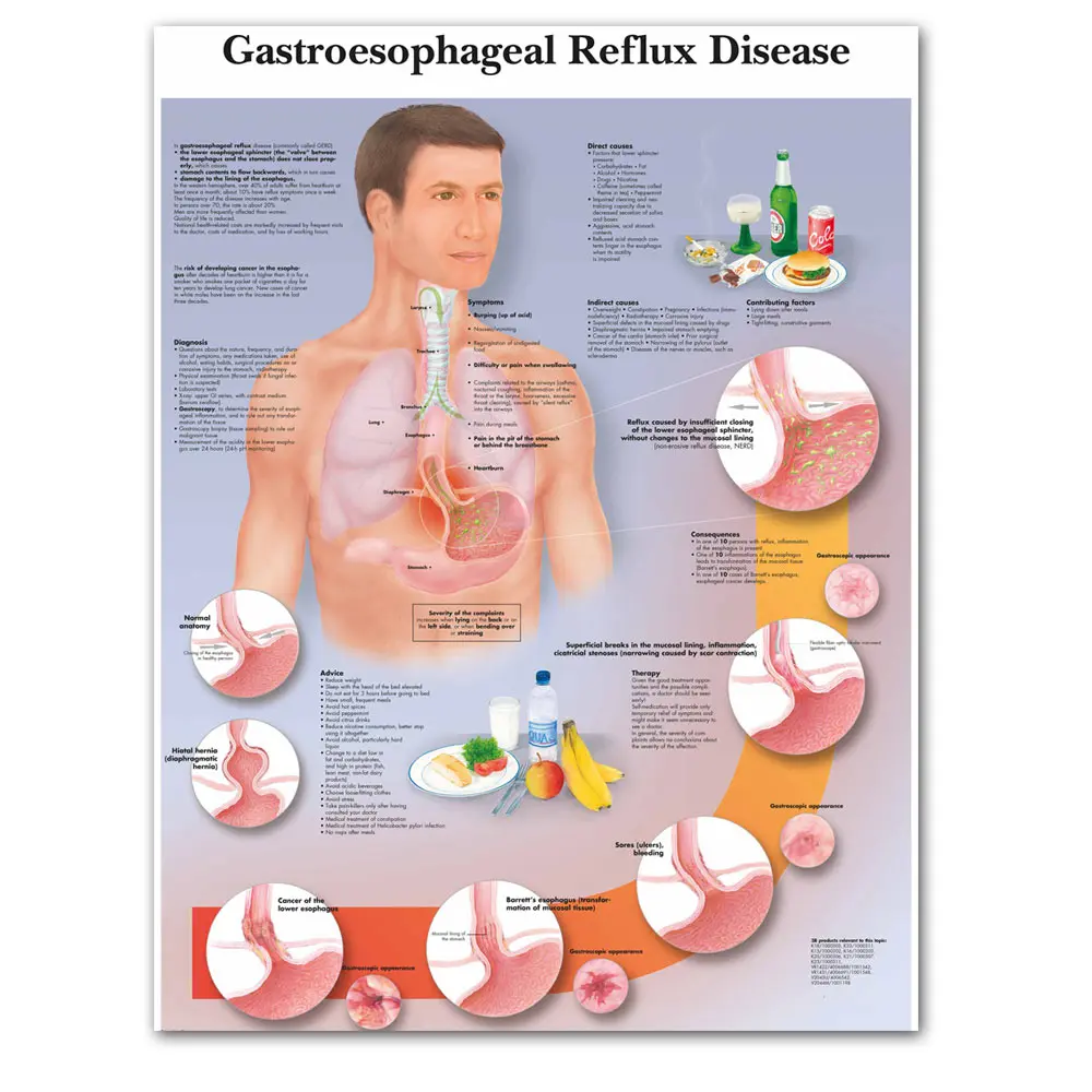 

Gastroesophageal Reflux Disease Chart Poster Print Canvas Painting Wall Pictures for Medical Education Doctors Office Classroom