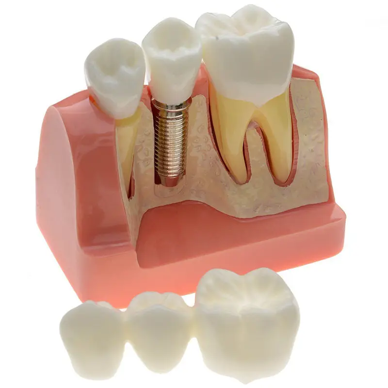 Стоматологическая демонстрационная модель зубов анализ имплантата крона моста