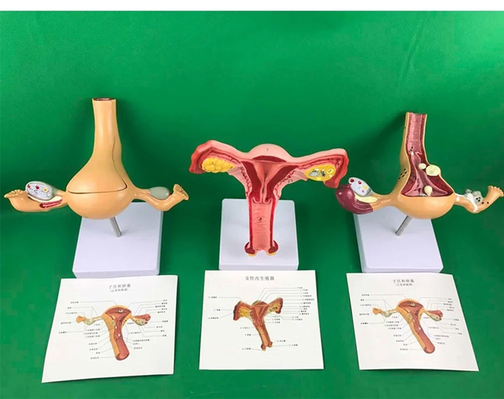 

Ovary and uterus disease Dissection model Pathology Female uterus model teaching human medical aids anatomy lesion uterus