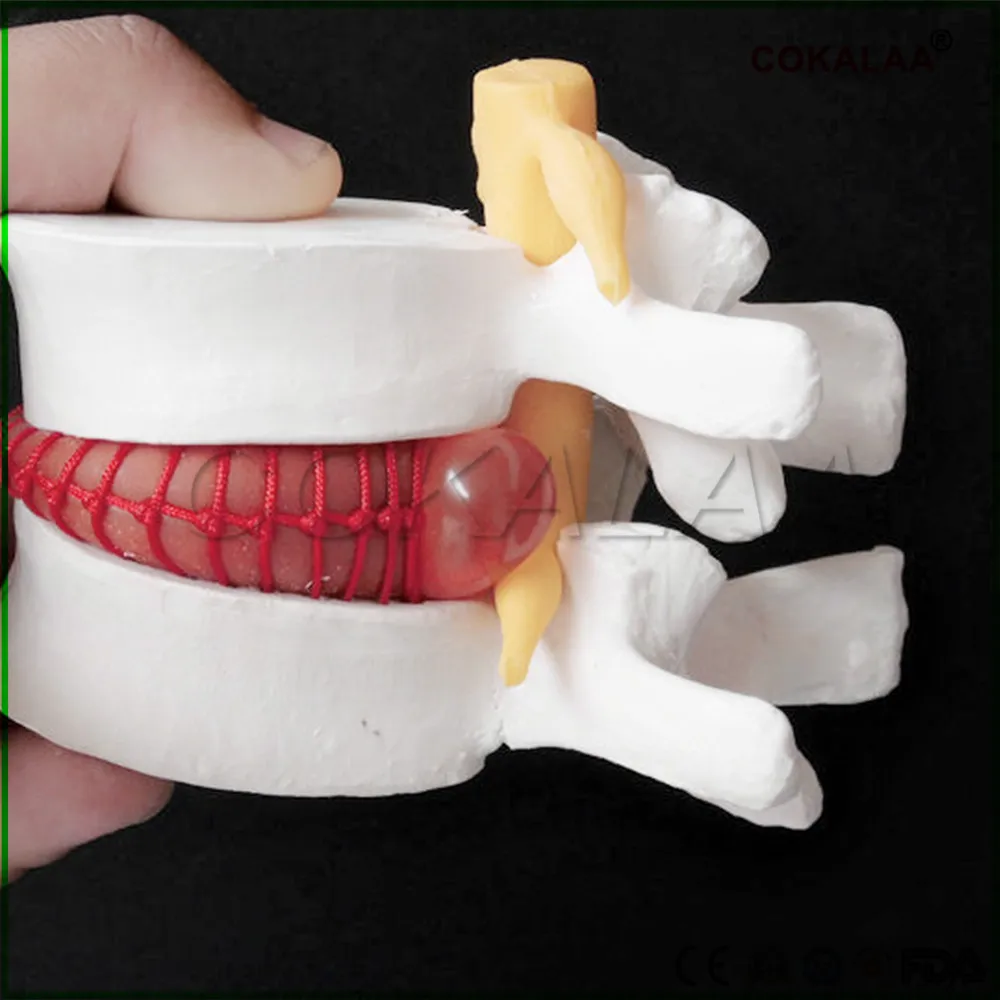 эндопротезы поясничного межпозвонкового диска м6-l. фиксатор позвоночника "страйкер спайн". имплантаты зиммер позвоночный. протез межпозвонкового диска m6. спондилодез поясничного отдела позвоночника кейджем.