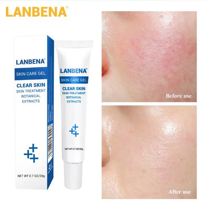 

LANBENA Acne Treatment Gel Acne Cleaning Cream Blackhead Remover Acne Spots Face Acne Scars Skin Care Repair Comedone Pimple