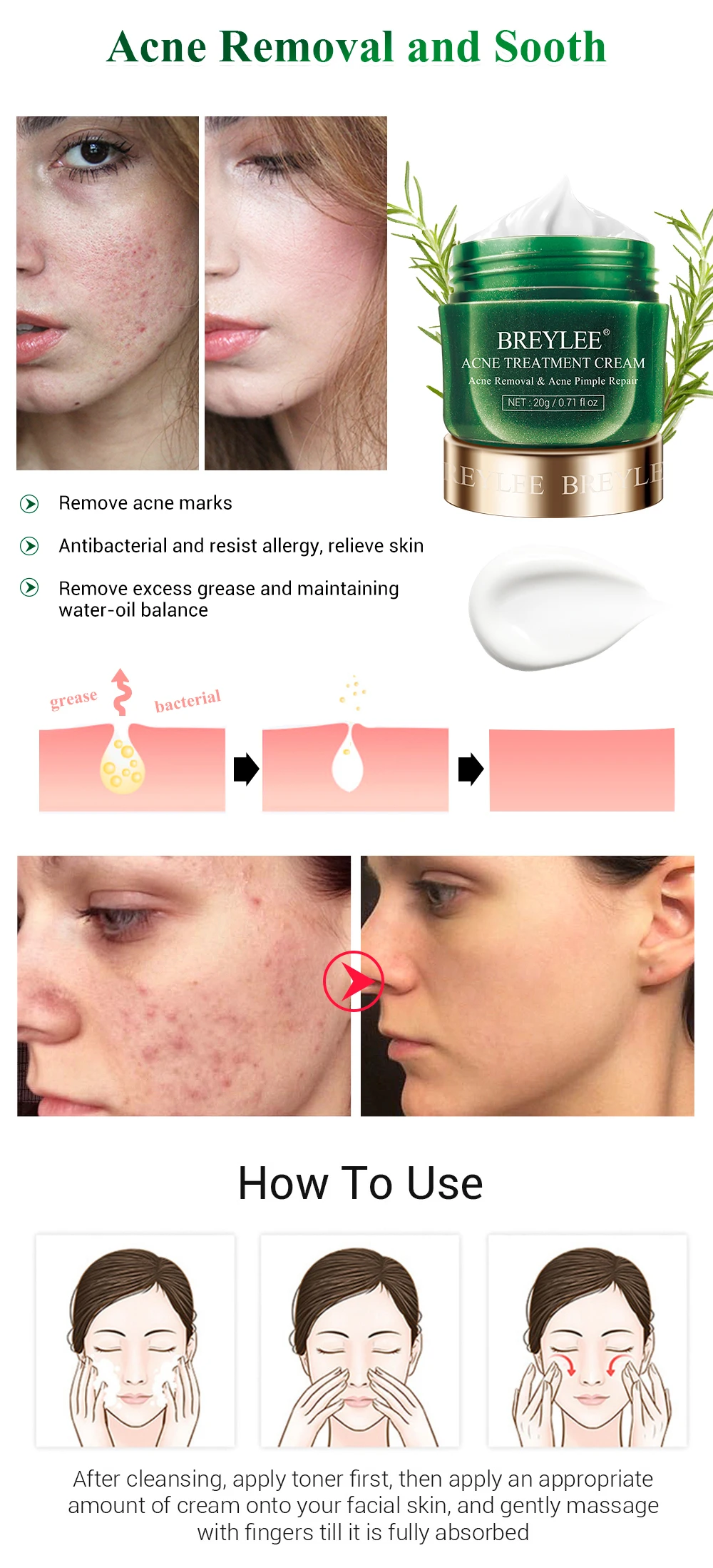 Newproduct BREYLEE Acne раствор набор акне лечебная сыворотка крем Пятна Прыщи эссенция для удаления против рубцов от акне кожа щадящий крем для лица