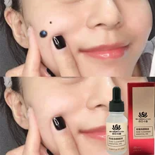 

20ML Mole & Skin Tag Removal Solution Serum Painless Mole Skin Dark Spot Spots Removal Freckle Removal Cream Facial Mole Rapair