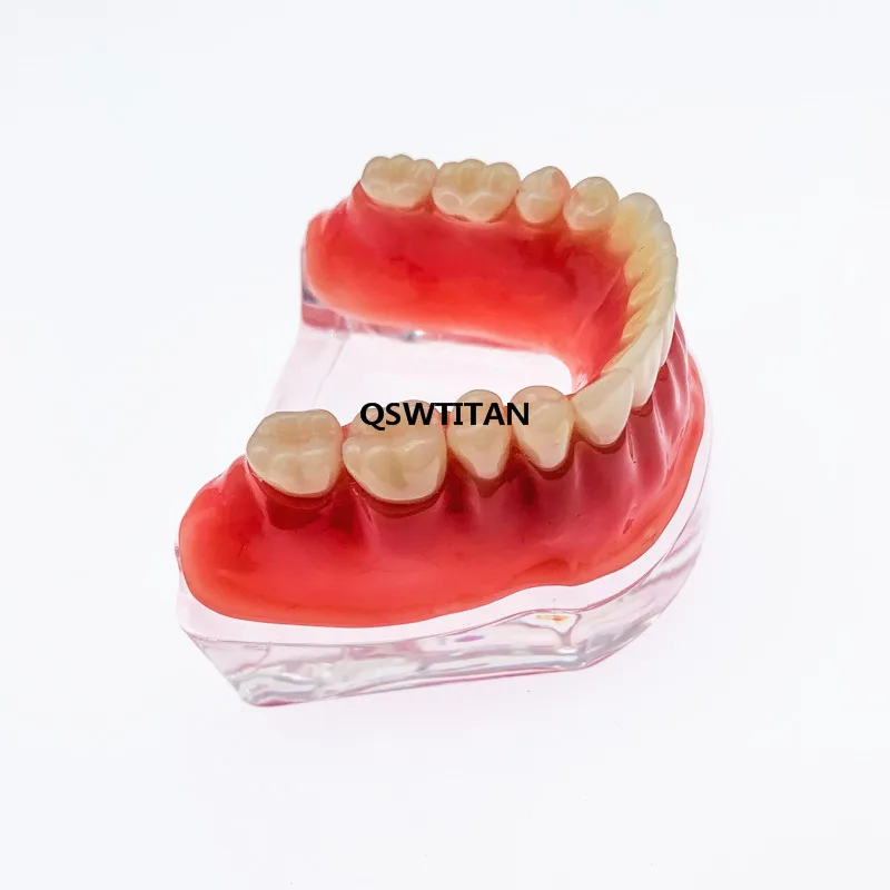 Repair teeth model with implant with Silver Bar Denture Teeth