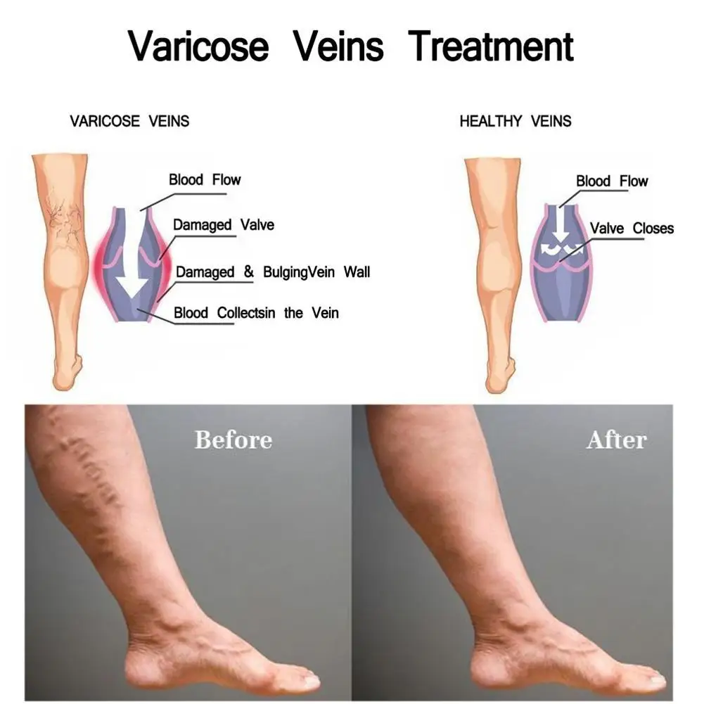 Китайский травяной крем для лечения варикозного расширения вен, мазь, васкулит, массаж ног, удаление варикозного расширения вен, пластырь