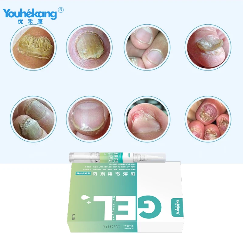 Youhekang 5 г уход за грибковыми ногтями, сыворотка для ухода за ногами, гель для удаления грибка для ногтей, против инфекции, парониксия, онихомикоз