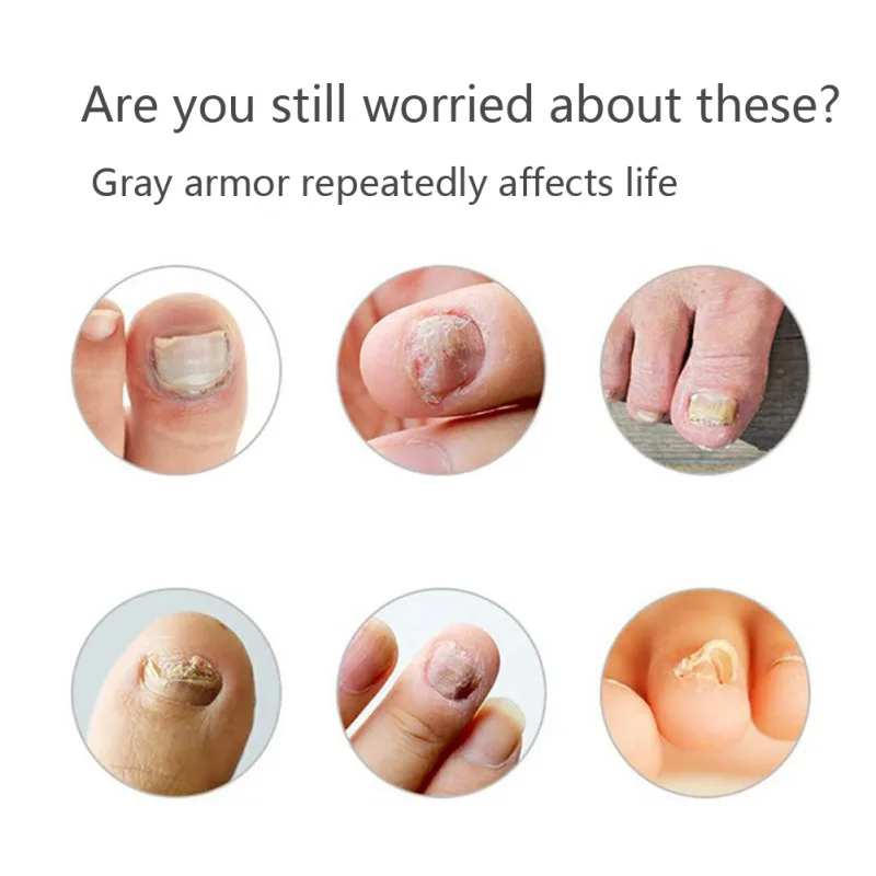 30ml Effective Removal Liquid Remove Fungus Sterilization Nail Repair Liquid Nail Treatments
