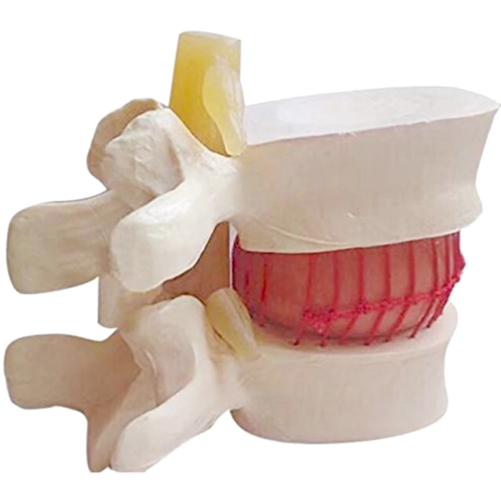 

1pc Anatomical Lumbar Disc Herniation Lumbar Spine Model White Color JFlyer