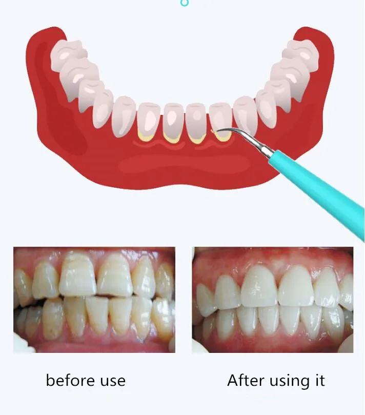 Портативная электрическая звуковая зубная скалер для удаления зубных пятен приспособление для Тартара CJJJJTYS00557