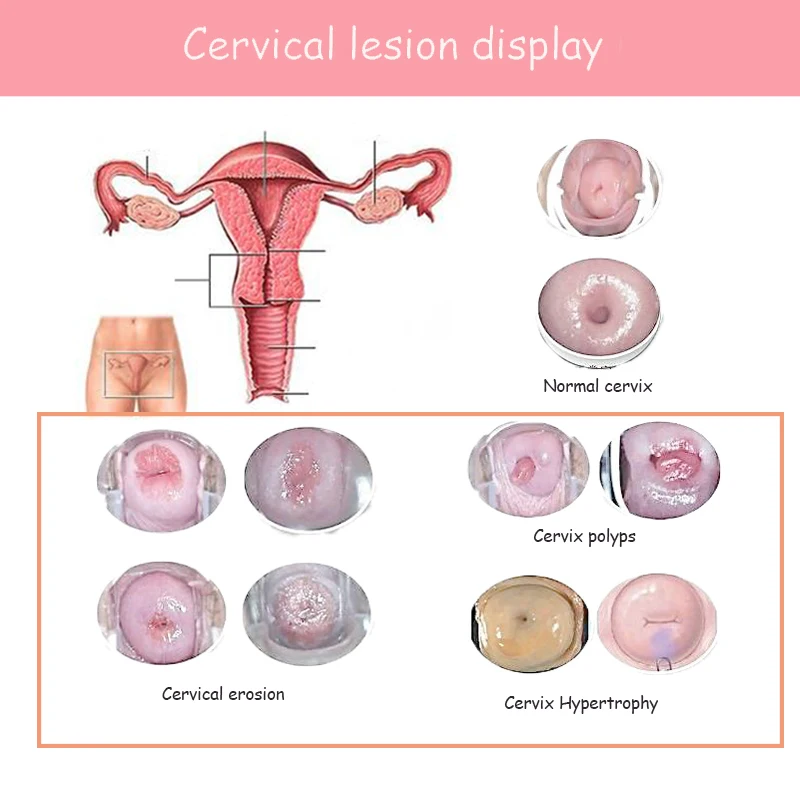Женский вагинальный краситель диспареуния мягкий неспецифический вагинит гинекологический терапевтический инструмент