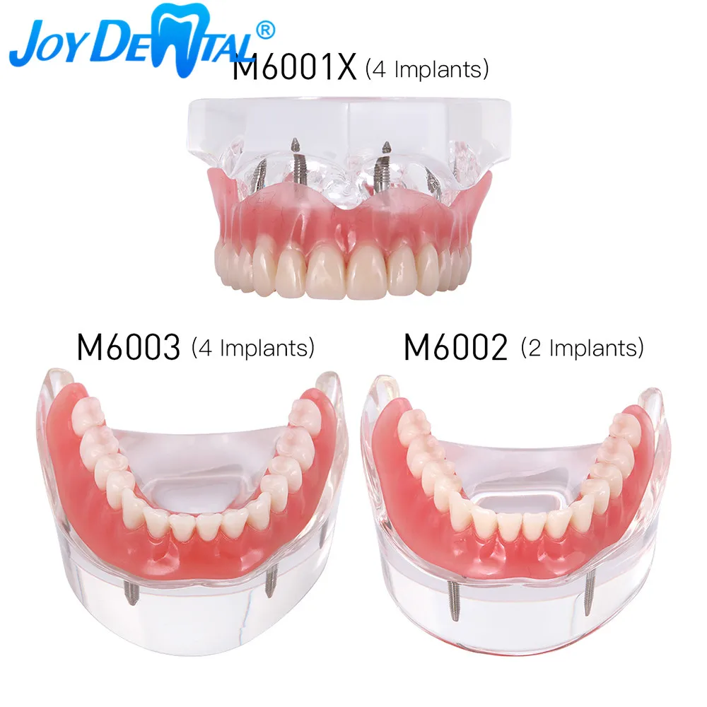 

Dental Implant Teeth Model Demo Overdenture Restoration With 2/4 Implants Upper Maxillary Lower Mndibular Clear Acrylic Model