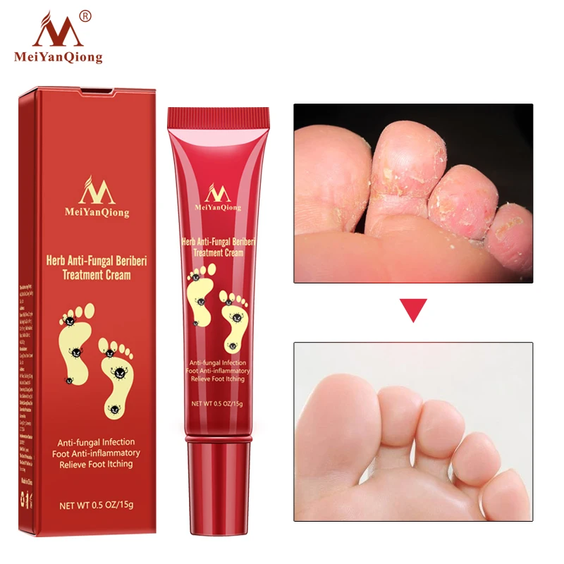 Herbal Foot Treatment Anti Fungal Infection Onychomycosis Paronychia Effective Toe Fungus Treatment Feet Repair Cream foot care5