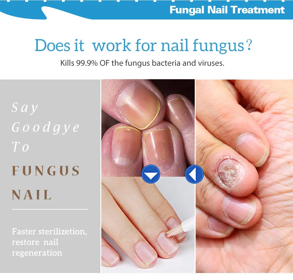 Nail Treatment Pen Onychomycosis Paronychia Anti Fungal Nail Infection Chinese Herbal Toe Fungus CareRepair Serum 10PCS nail fungus treatment nail care oil nail cuticle oil pen nail care kit