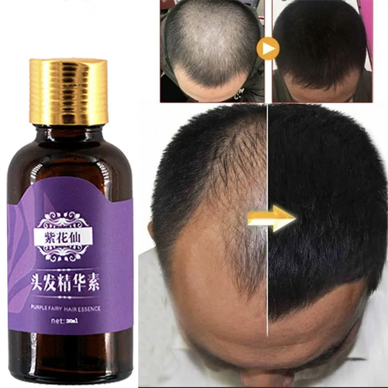 Natural With No Side Effects Hair Care Essence Prevention Hair Loss  Effective Fast Hair Growth Nourishes Oil Control Repair - AliExpress Beauty  & Health