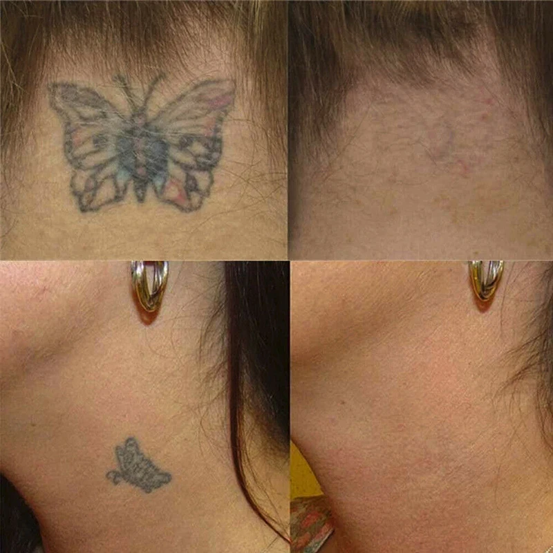 Новинка безопасный крем для удаления перманентных татуировок, очищающий крем для тату, применимый к большинству частей тела, инструмент для татуировки T1