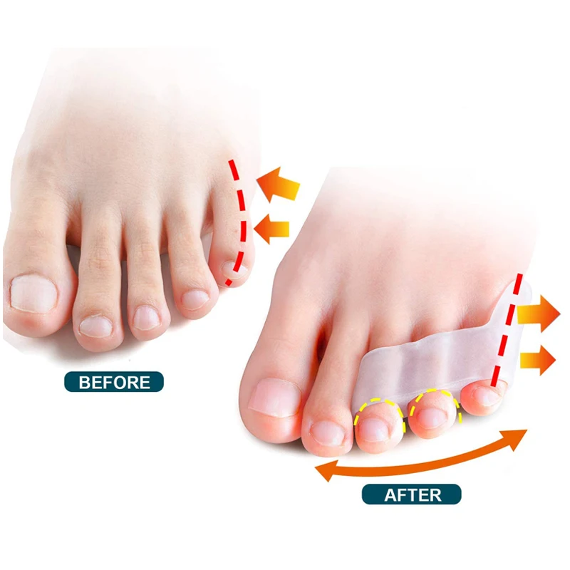 2pcs Toe Separator Overlapped Toe Hallux Valgus Correction Bunion Blister Pain Relief  Little Finger Protector Foot Care Tool 4 6 10pcs finger toe protector silicone gel tube bundle prevent friction foot blister calluses pain relief hallux separator tool