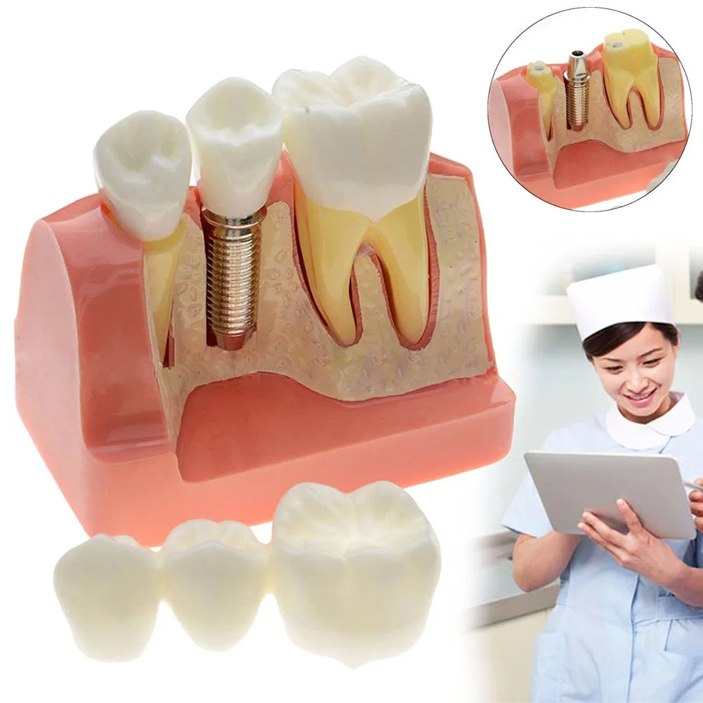 Профессиональная Стоматологическая модель зубов прозрачная патологическая модель нерва имплантата для медицинских исследований