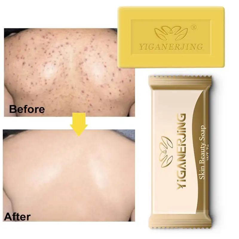 

1 Pc Oil Control Acne Treatment Sulfur Soap Blackhead Remover Skin Clearing Soap New Anti Fungus Anti-mite Tool TSLM2