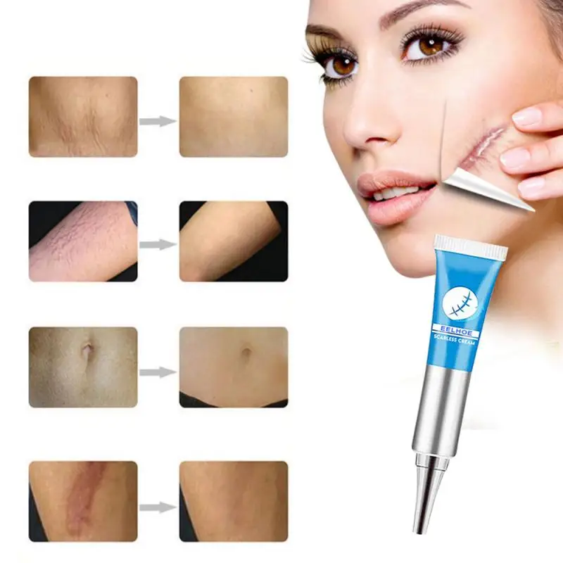 eelhoe scar removal cream